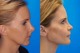 Cheek Augmentation in Dubai UAE