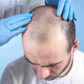 Hair Transplant Without Shaving in Dubai