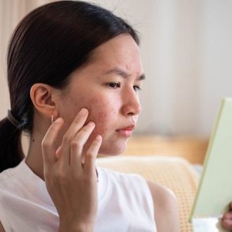 Instant Anti Acne Treatment Dubai UAE