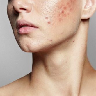 Laser Scar Removal Cost in Dubai