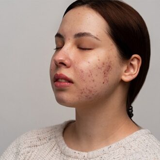 Brad Pitt’s Acne Scars Treatment in Dubai