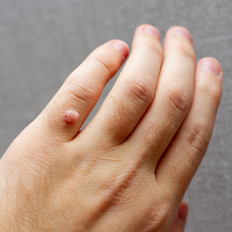 Cryotherapy for Warts in Dubai