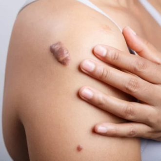 Keloid Scar Removal Cost in Dubai UAE