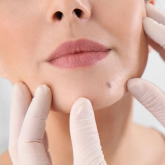 Mole Removal Cost in Dubai