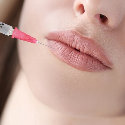 How Much Do Lip Fillers Typically Cost?