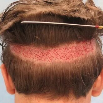 Robotic Hair Transplant Cost in Dubai