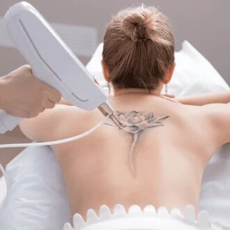 How Effective is Laser Tattoo Removal?