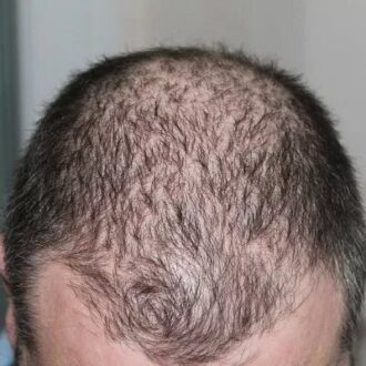 Cost of FUT Hair Transplant In Dubai & Abu Dhabi