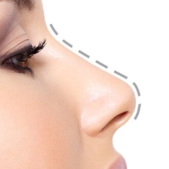 How Permanent Is Rhinoplasty