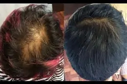 Stem Cell Hair Transplant before & After