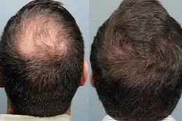 Stem Cell Hair Transplant clinic in Dubai & Abu Dhabi
