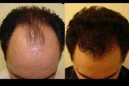 Stem Cell Hair Transplant in Dubai